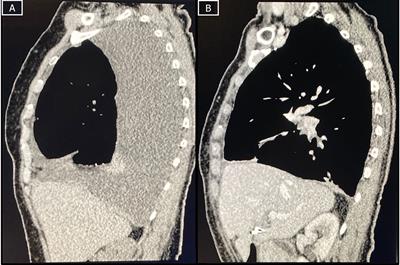 Complete Pathological Response After Neoadjuvant Chemo-Immunotherapy in Malignant Pleural Mesothelioma